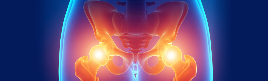 Artrosi dell'anca trattabile con la medicina rigenerativa.